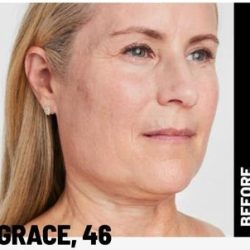 Ultherapy Before & After Patient #1545